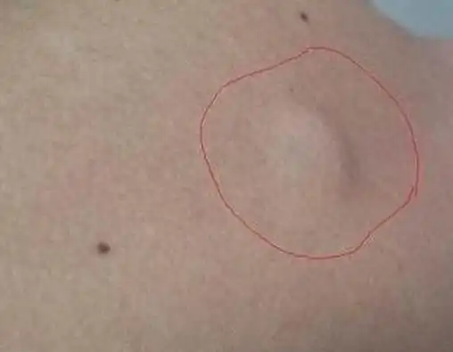 皮下脂肪瘤会不会影响健康