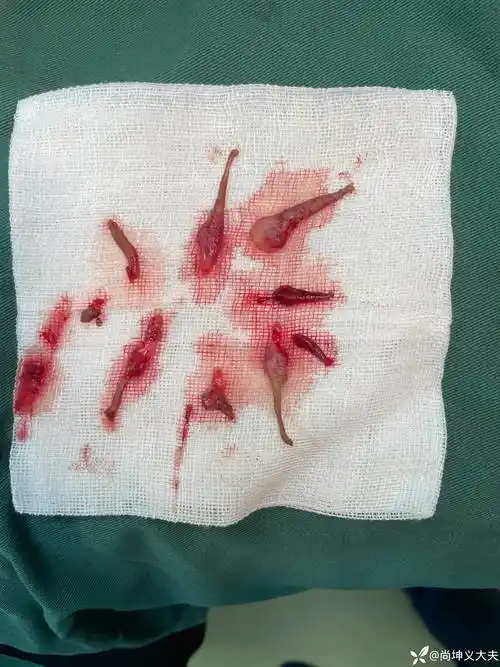 环状混合痔外剥内扎术