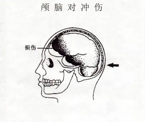 为什么后脑勺摔伤千万要小心-看看这里就知道了