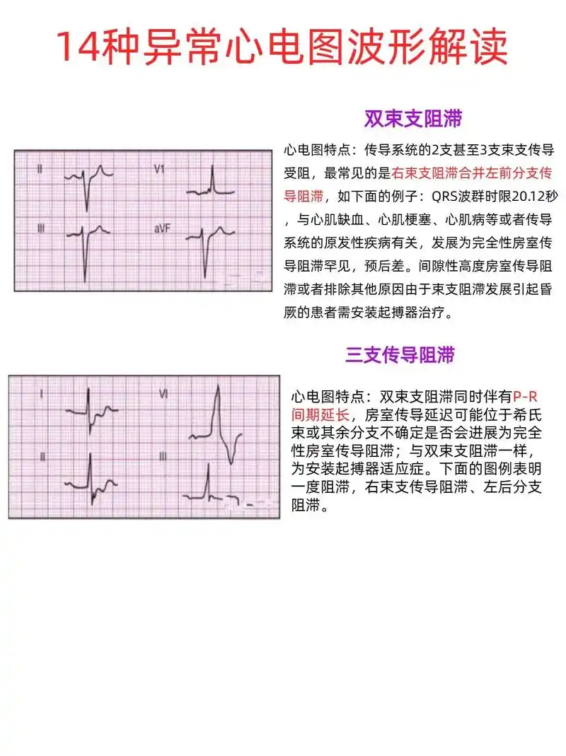 专题心电图精解 - 抖音