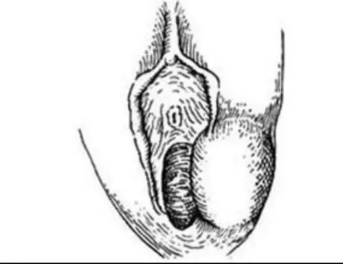 其它 助力女性健康,我们"切囊相助" 写美篇前庭大腺炎症由病原体侵入