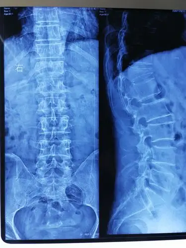 王济田胸12椎体chance骨折