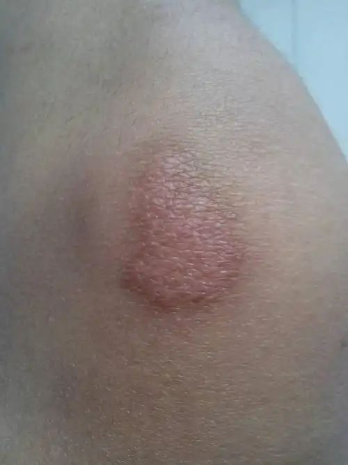 我是个女孩,13岁,这个是今年4月17日运动会不慎摔倒留的疤,我知道疤痕