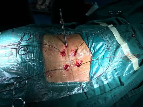 完全内镜下腰椎融合术