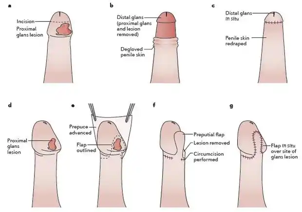 拍摄的,患者是一位60岁的中年男性,发现阴茎及冠状沟红色肿物半年就诊