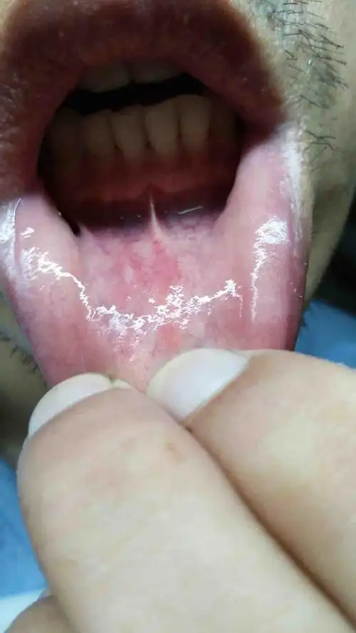 口腔长了个小点,十天左右了,刚开始是个小红点,后变成白点