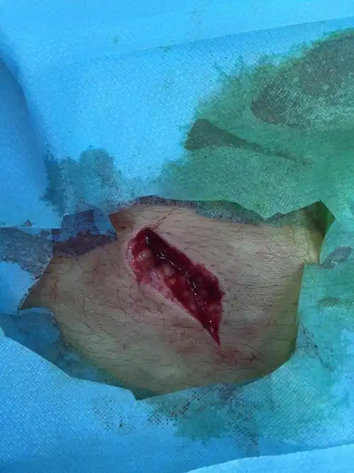 我被人拿匕首捅伤,捅到腰部,伤口长4厘米,深8厘米,头部也有刀伤,是否