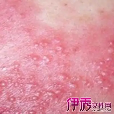 【图】肛门湿疹症状有哪些 湿疹治疗几种方法