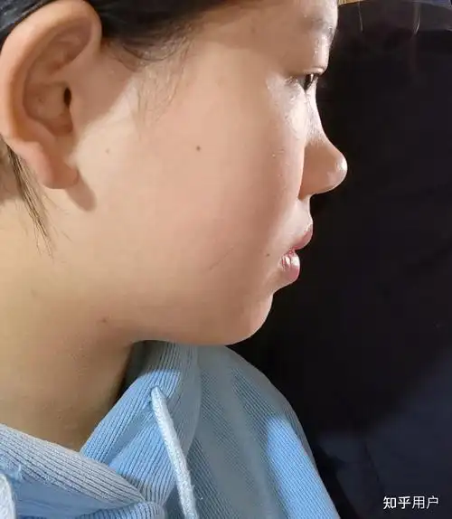 没有鼻梁,鼻子塌的人是什么体验? - 知乎