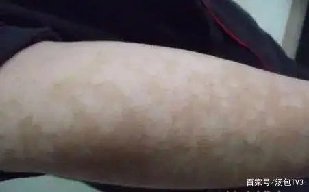 26岁小伙每天运动,排出的汗水成了汗斑,竟会传染