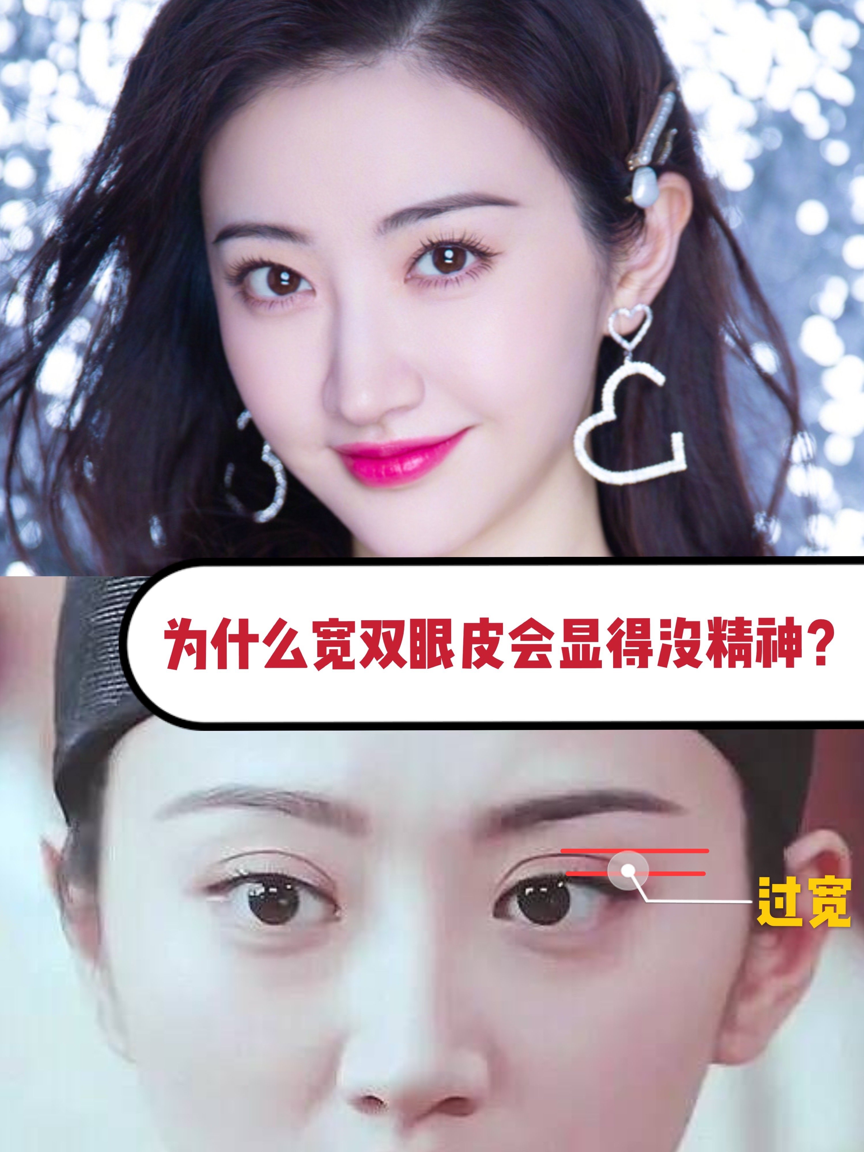 整了青蛙眼后的景甜重新美回巅峰,为什么宽双眼皮会显_圈子-新氧美容