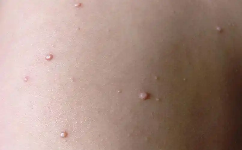 冠状沟珍珠疹图片珍珠疹龟头炎图片