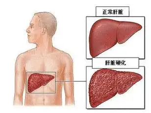 身体若有4处"异常",或许是"肝病"前兆,建议尽快检查