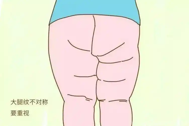 几个小细节教你查看宝宝发育状况,腿纹对称就是其中一个,快学