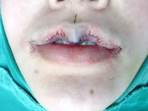 今天刚做完微笑m唇,肿胀感不明显,手术过程大概半个_圈子-新氧美容