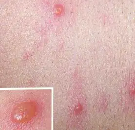 不同时期时尖锐湿疣的症状