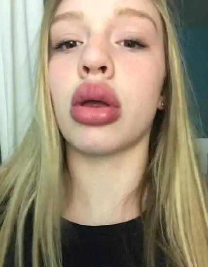 没想到,用了之后嘴唇却软组织坏死了,乌青,向外翻凸,像香肠,需要外科