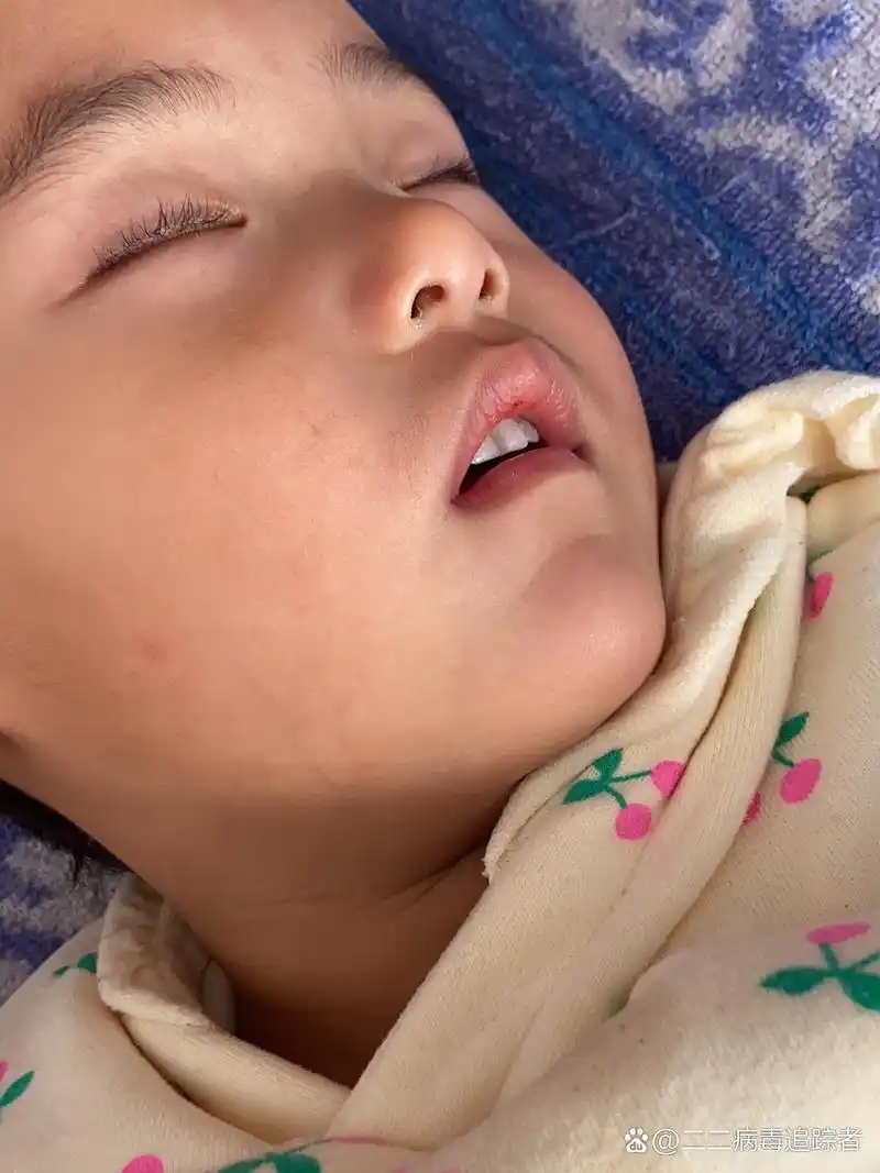 腺样体肥大前后对比照,我家宝宝之前打呼噜张嘴睡觉,我本来以为是感冒