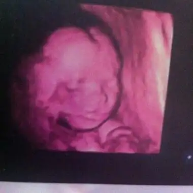 我怀疑我的宝宝是兔唇,我好担心我该怎么办