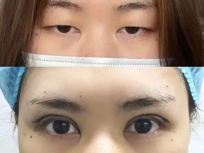 切割双眼皮术后恢复!#全切双眼皮