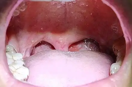 睡眠呼吸暂停综合征_治疗方式_日常注意事项 - 好大夫在线