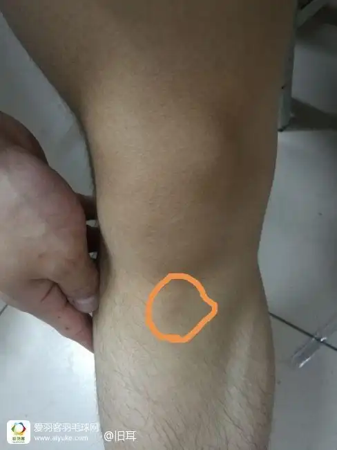 小腿骨头这块感觉有轻微的凸起咋回事