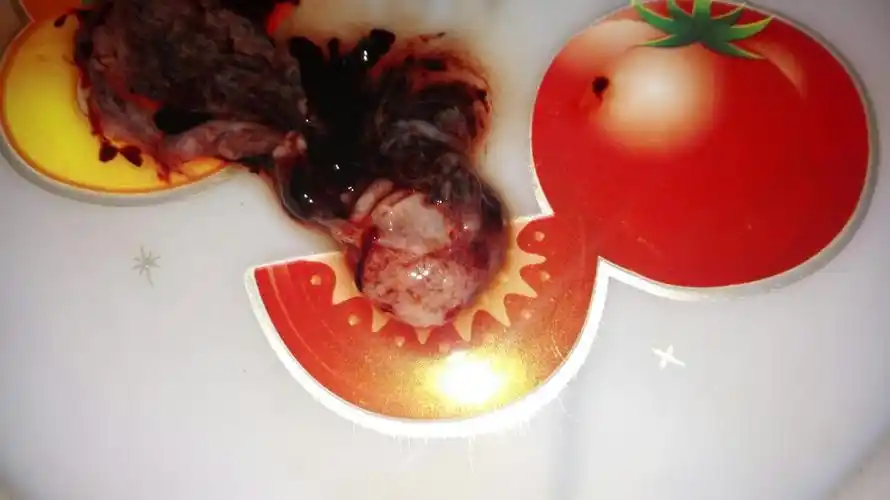 服用米索前列醇片七小时后排出物,请问这是孕囊么