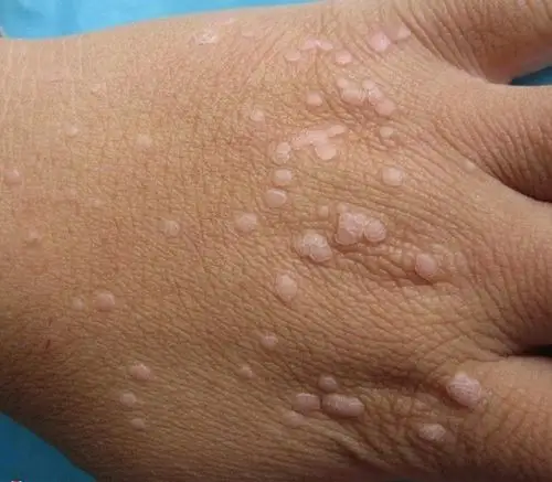 丝状疣的对比图片