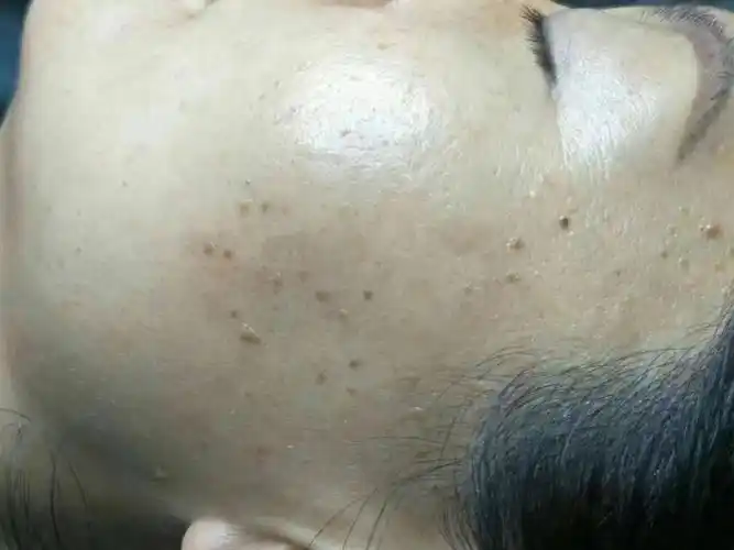 还谈什么用的雅诗兰黛,海蓝之迷呀,赶紧来找我们给你把疣祛了吧98