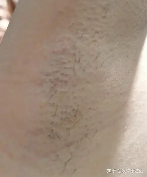 女生怎么脱腋毛有什么靠谱的脱毛膏推荐