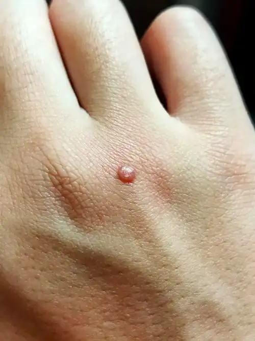 一开始是红色,过几天出现了角质化——"恭喜"我,获得了又一个寻常疣