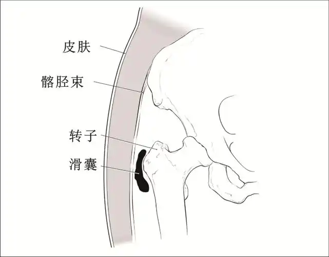 大转子滑囊炎是股骨大转子滑囊无菌性炎症反应和局部的增生肥大.