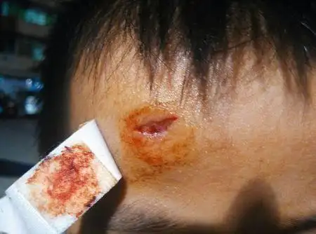 问:小孩子头破了 这样子用不用连线?