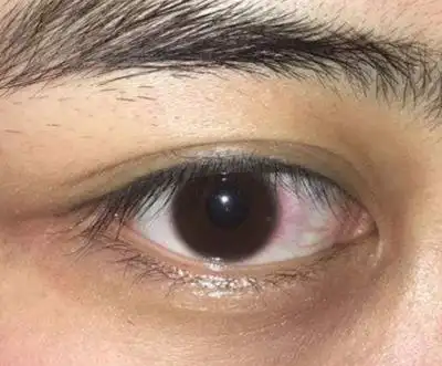 眼角膜发炎图片 (36)