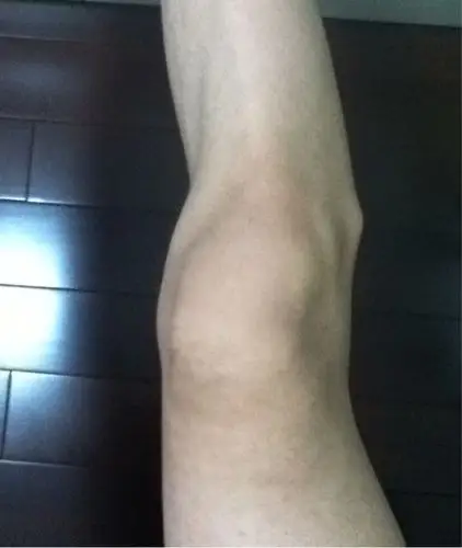 膝盖外侧骨头突出图片