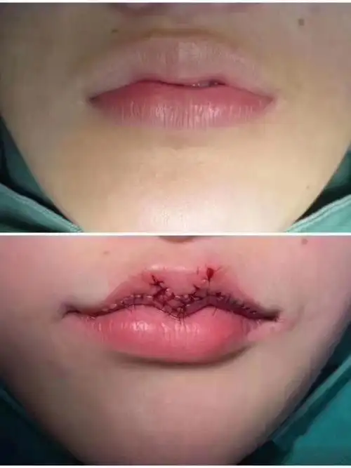 做了媚唇手术,之前一直对自己嘴长的很不满意,终于下定决心做了它了.