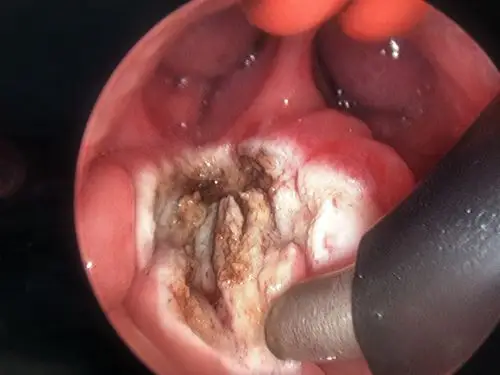 (附手术过程图片)_扁桃体炎_治疗方式_介绍_症状表现 - 好大