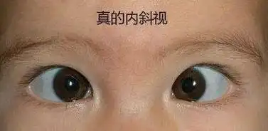斗鸡眼?教您一个自测小妙招,准确分辨真假斜视