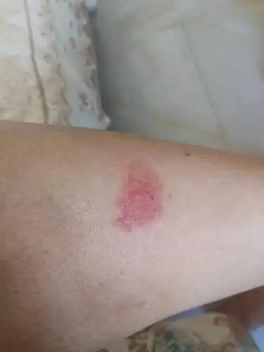 被不知道什么虫子咬了,皮肤红肿,特别痒,并且一周多也不消退,请问大概