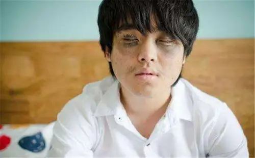 为什么会有黑眼圈?为了消除黑眼圈多久用一次眼膜贴比较好?