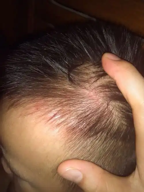 一岁半的小宝宝从一米的高空摔下来,头部这个摔的比较严重,但是不知道