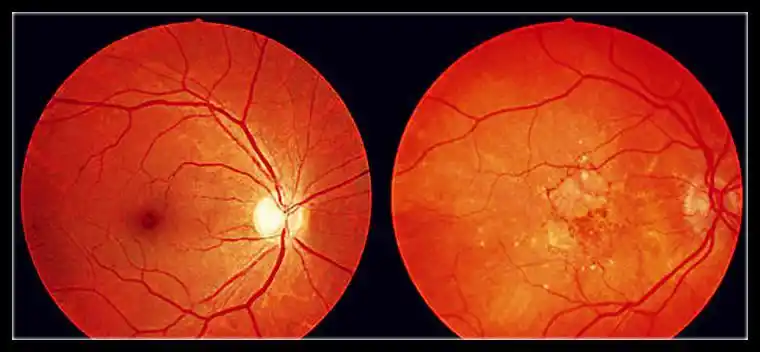 线,红外线光波以及营养不良,老年人衰老性黄斑都可能导致眼底黄斑病变