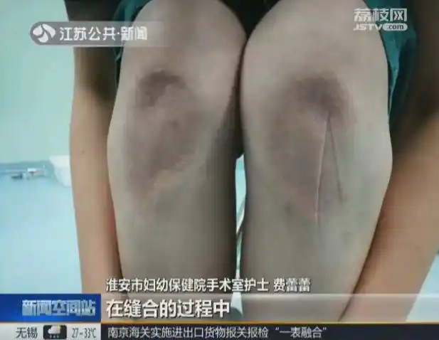 凹陷,青紫……但,这是我见过的最美膝盖!