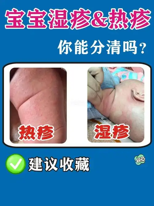宝宝湿疹热疹一分钟认清,乱护理可不行