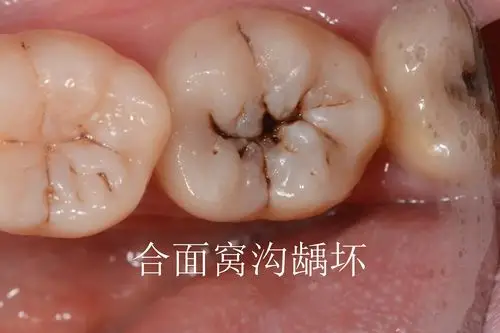 牙齿的好发龋损位置:一般合面(咬东西的面)>邻面(牙间牙面)>唇颊侧的