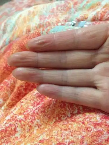 手上老是感觉干,而且出来竖纹两个月了,是人体缺水?缺维生素?