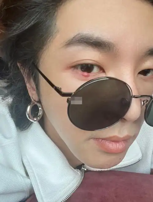 华晨宇忙得连轴转,晒自拍眼睛长了麦粒肿,提问是否要动手术?