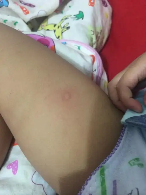 宝宝大腿内侧长了个绿豆大的红疙瘩.今天突然发现的,以前没有!