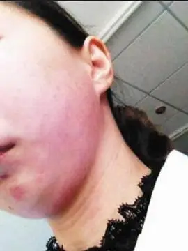 李晓莹被扇耳光后脸部红肿的照片