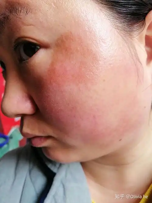 脸蹭掉皮三个月了色素沉着了怎么办会不会恢复不了了能恢复正常皮肤么